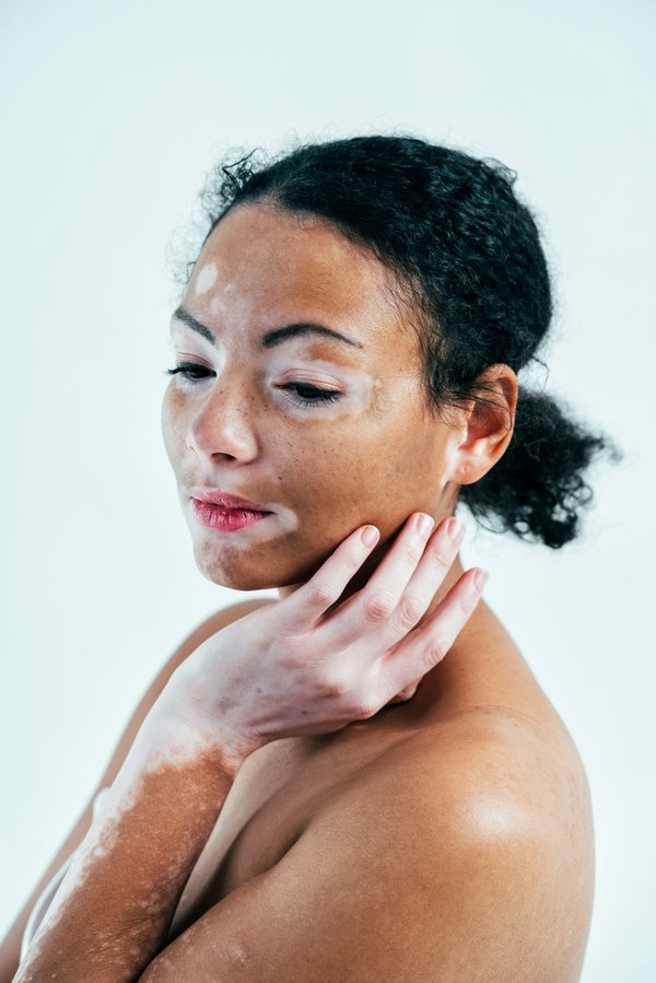 Lentigo : stratégies efficaces pour une peau lumineuse